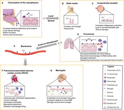 The Yin and Yang of Pneumolysin During Pneumococcal Infection